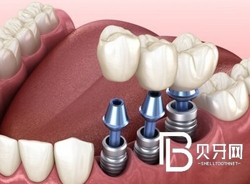 北京荷馬口腔看牙很貴嗎？醫(yī)院價(jià)格表告訴你實(shí)情！