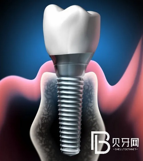北京種植牙的價(jià)格表公布：看看在北京種牙哪里便宜！