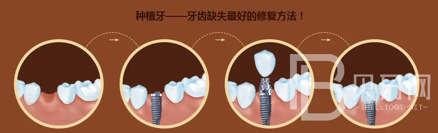 北京種植牙哪里好？北京德貝口腔怎么樣？