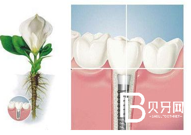 北京?？品N植牙哪家好？北京鈦植口腔全網(wǎng)超低價(jià)  ?