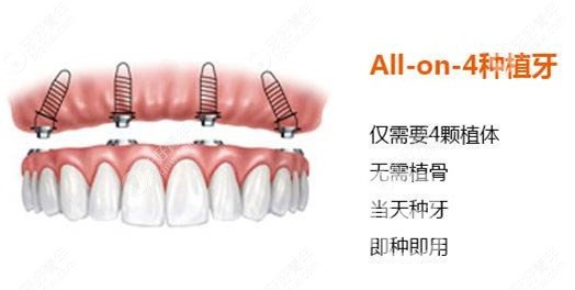 滿口種植牙需要種幾顆？北京佳美口腔正規(guī)嗎？